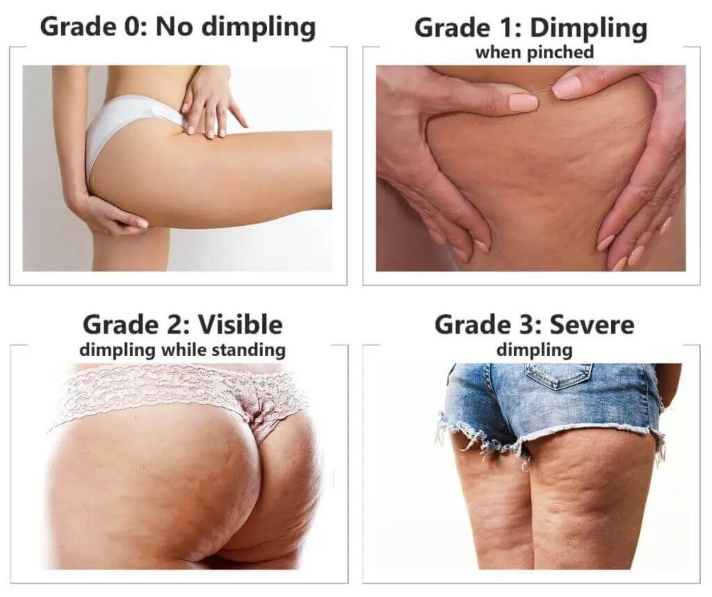 Representation of the stages of cellulite development Biggleswade